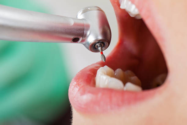 Best Emergency Wisdom Teeth Removal in Breezy Point, MN